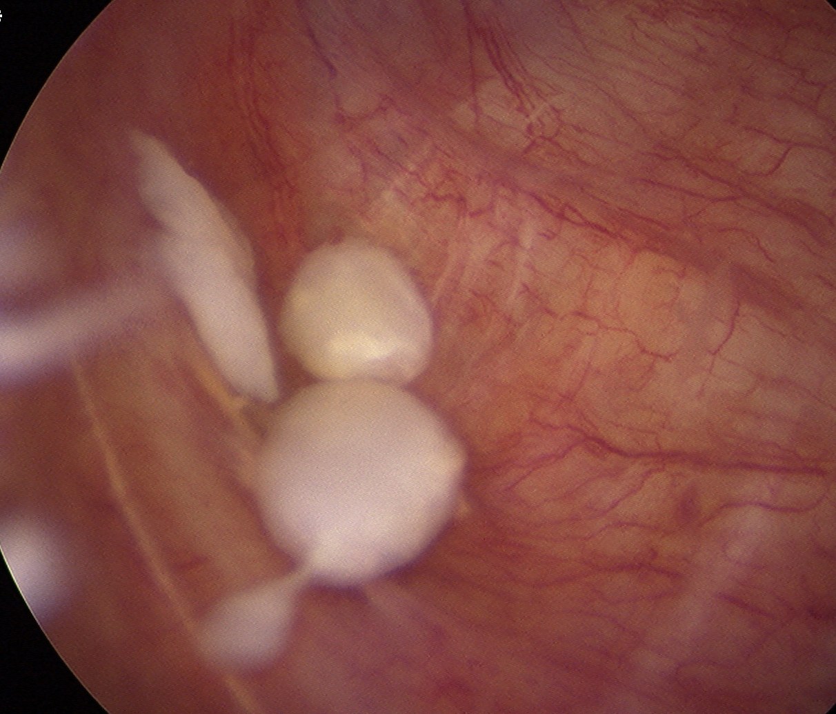 Secondary Synovial Chondromatosis